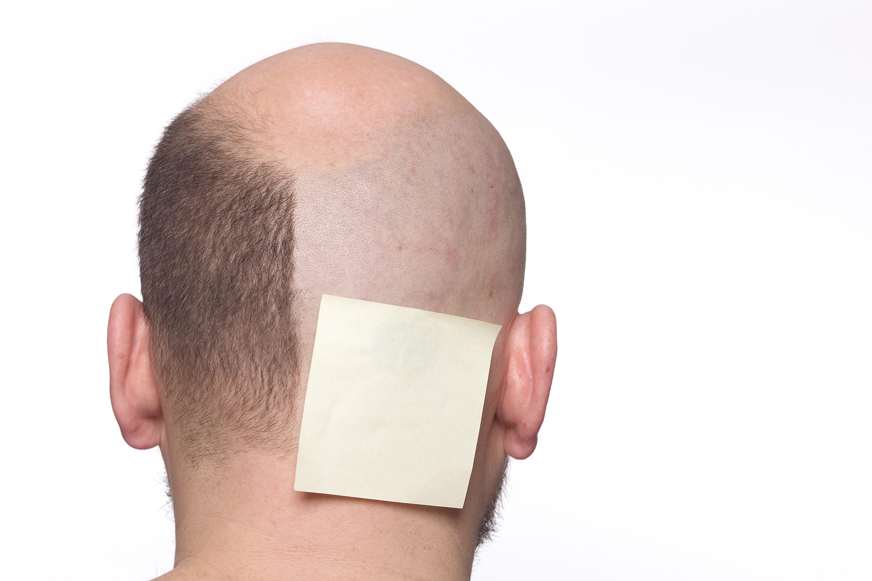 MALE PATTERN BALDNESS: THREE TREATMENT OPTIONS TO CONSIDER